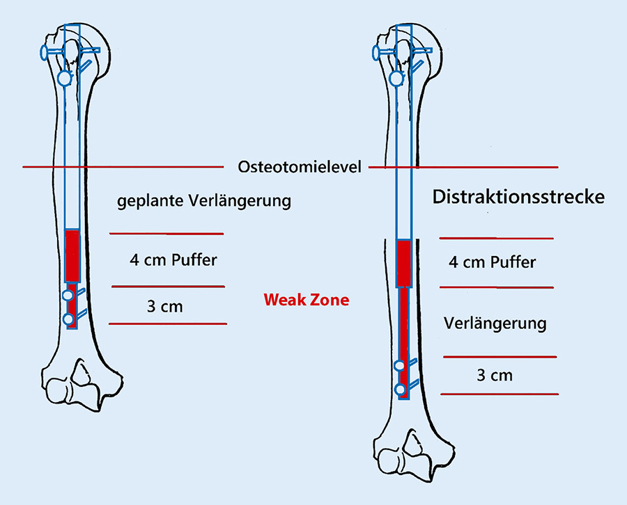 Intramedulläre Oberarmverlängerung