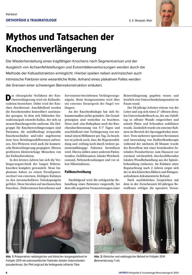 Mythos und Tatsachen der Knochenverlängerung