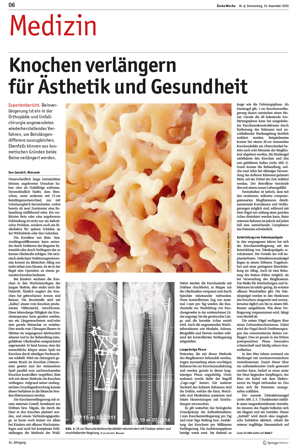 Knochen verlängern für Ästhetik und Gesundheit