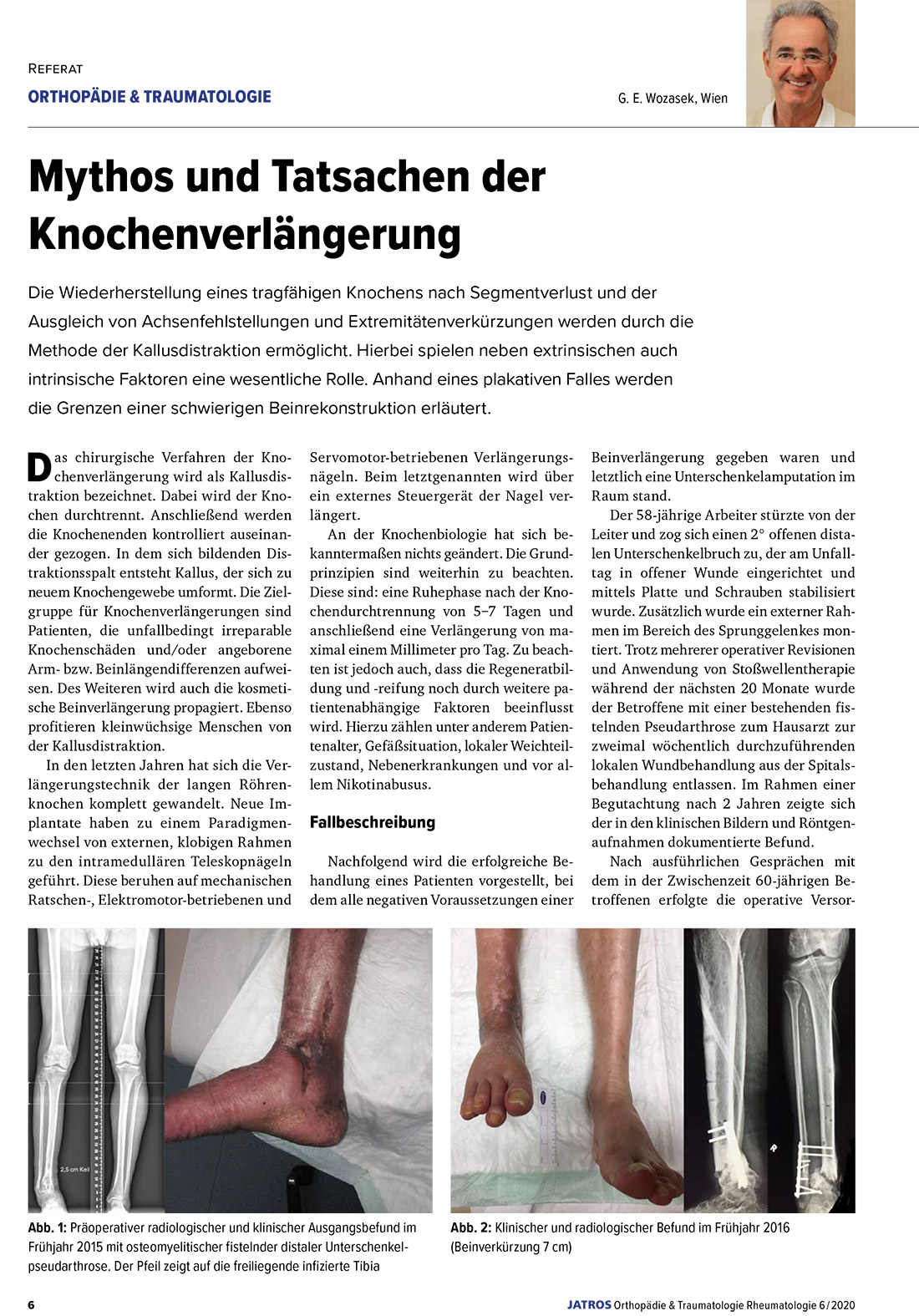 Mythos und Tatsachen der Knochenverlängerung